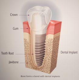 dental implant